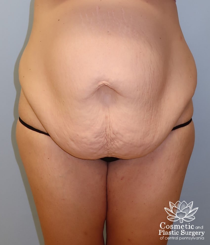 Tummy Tuck and Liposuction Before