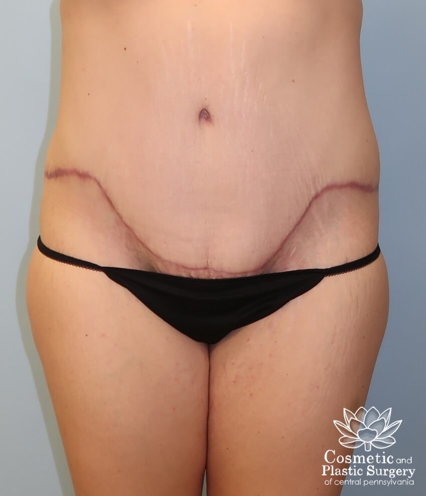 Tummy Tuck and Liposuction After