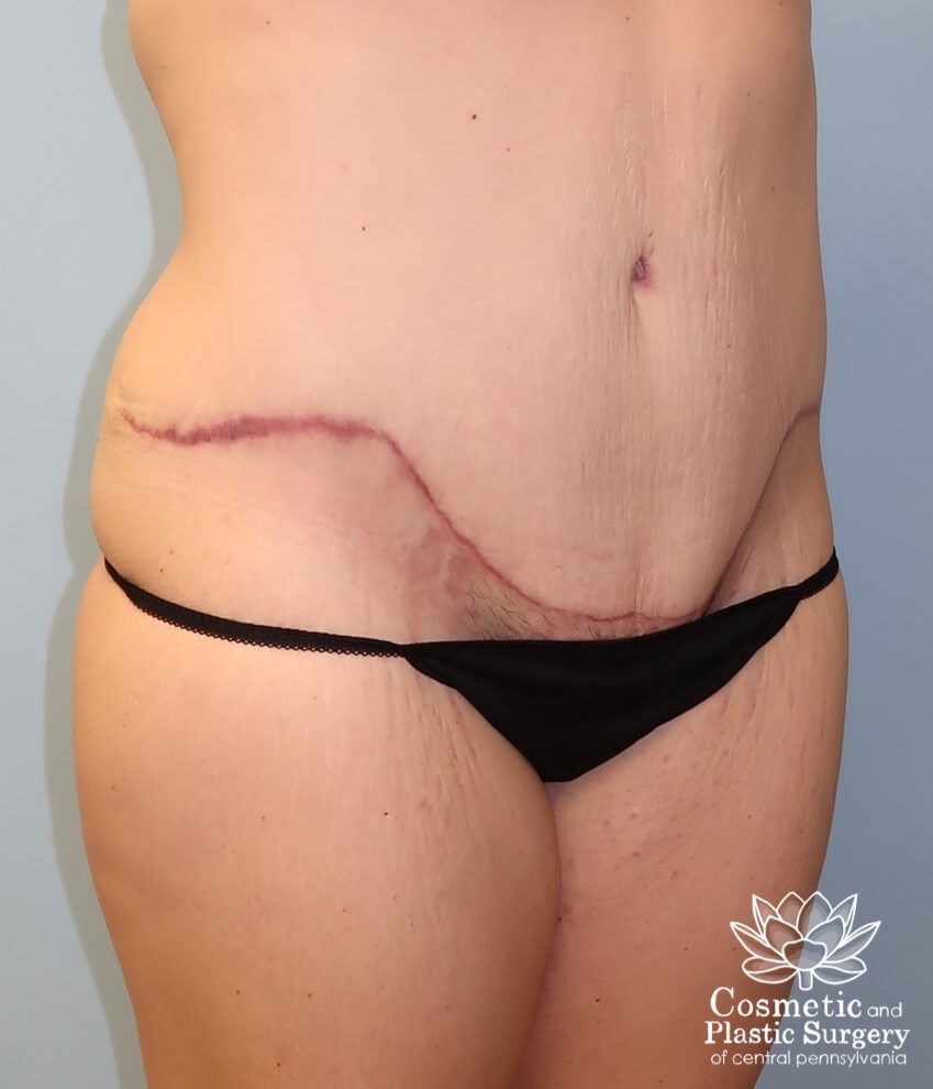 Tummy Tuck and Liposuction After