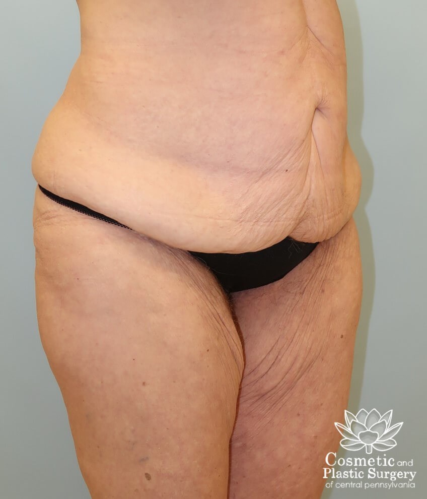 Circumferential Body Lift Before