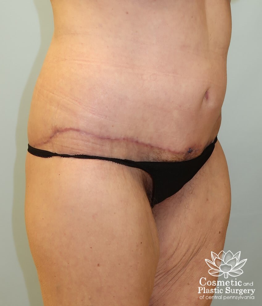 Circumferential Body Lift After