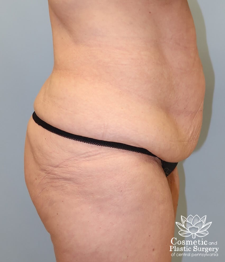 Circumferential Body Lift Before