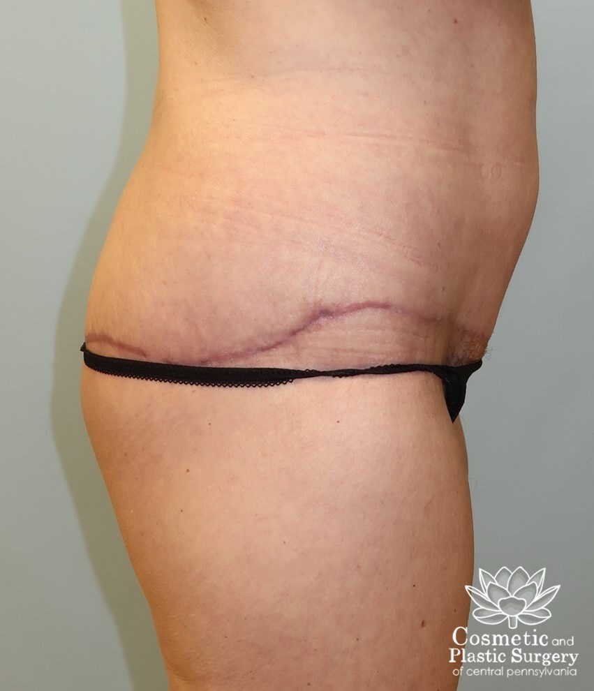 Circumferential Body Lift After