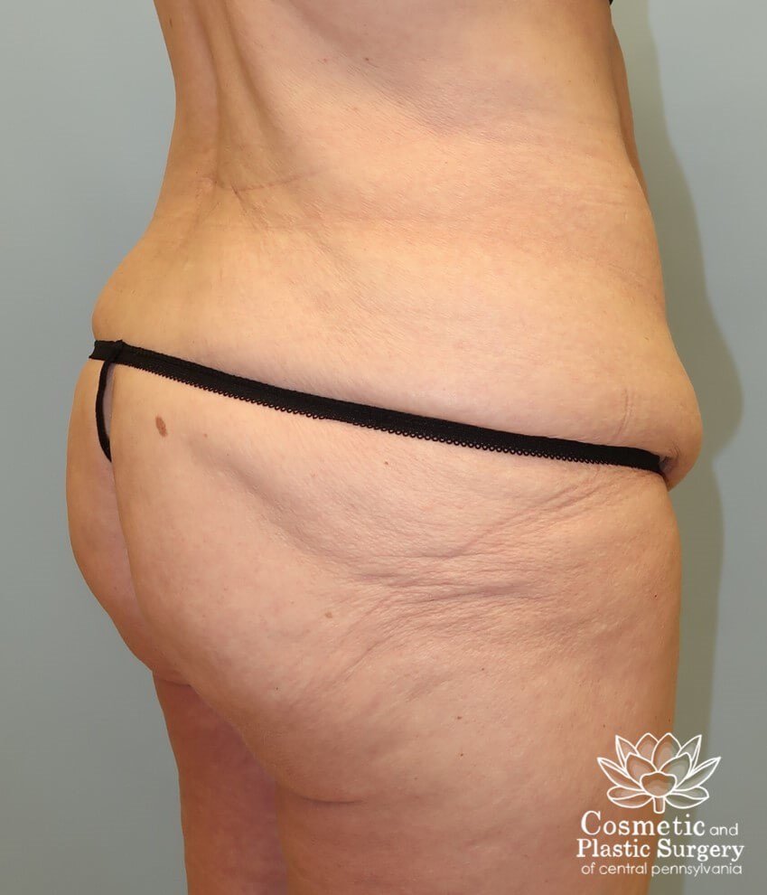 Circumferential Body Lift Before