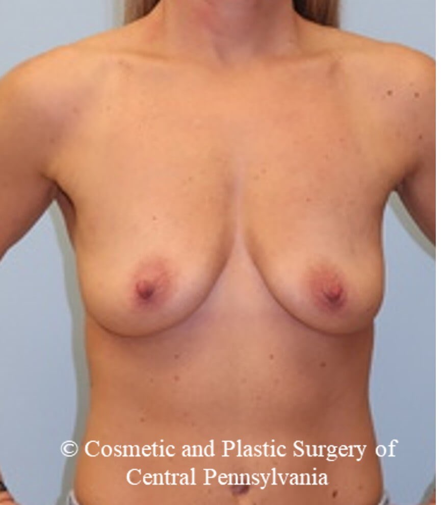 Breast Augmentation Before