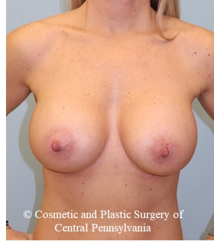 Breast Augmentation After