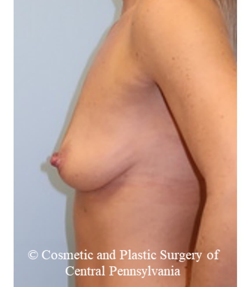 Breast Augmentation Before