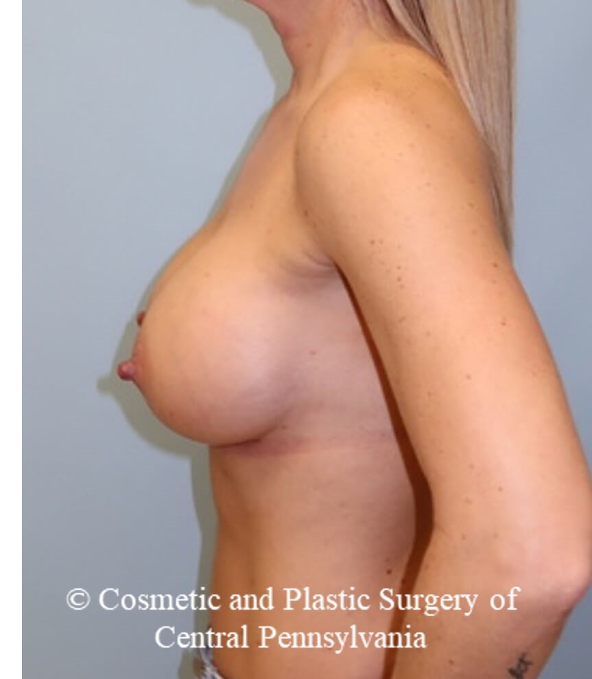 Breast Augmentation After