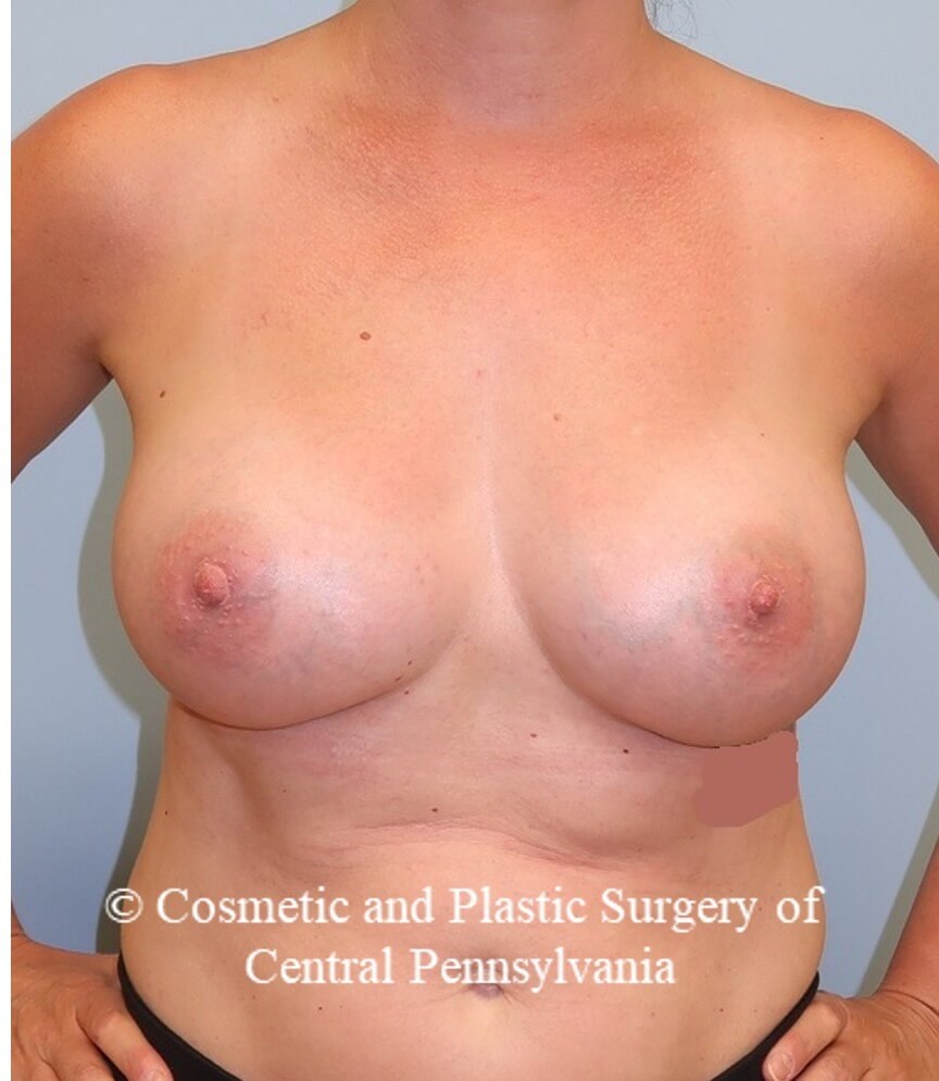 Breast Augmentation After