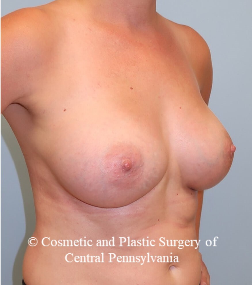 Breast Augmentation After