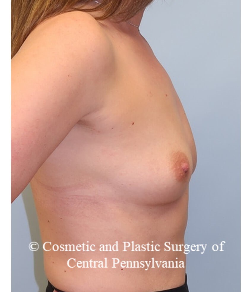Breast Augmentation Before