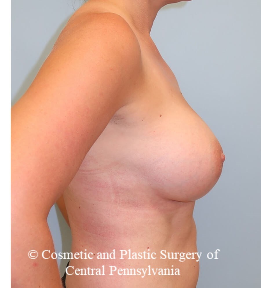 Breast Augmentation After