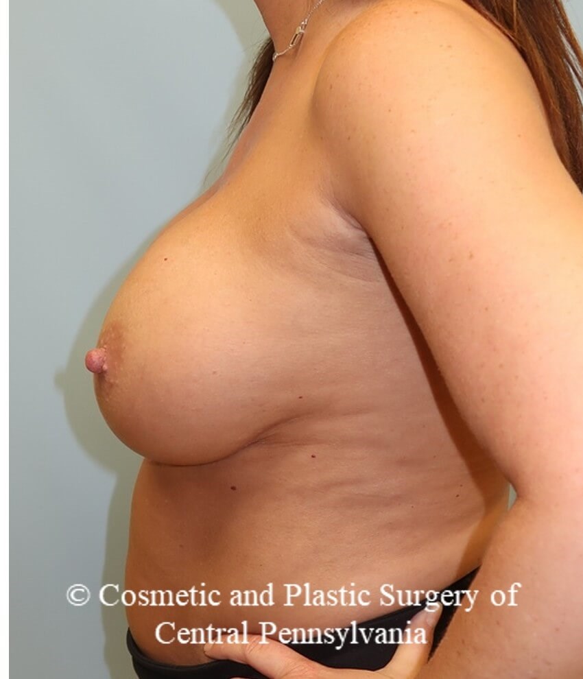 Breast Augmentation/Lift Before