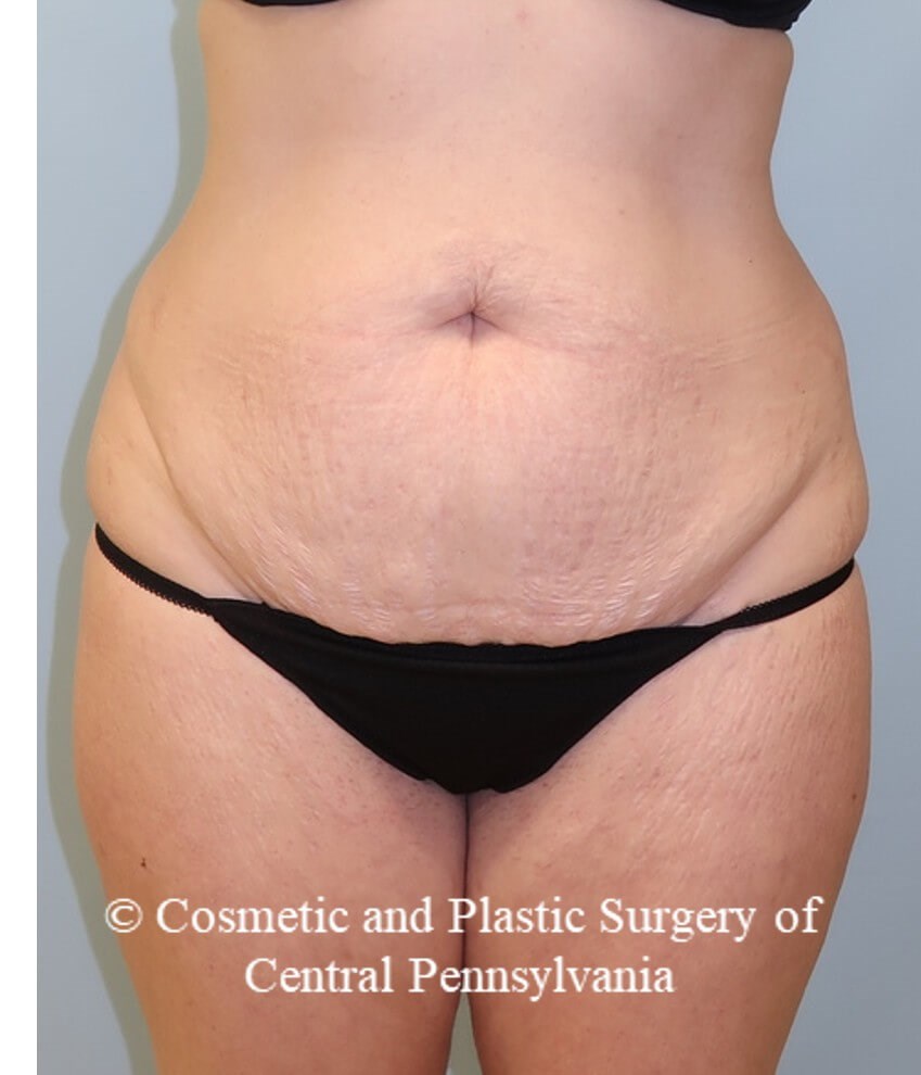 Abdominoplasty and liposuction Before