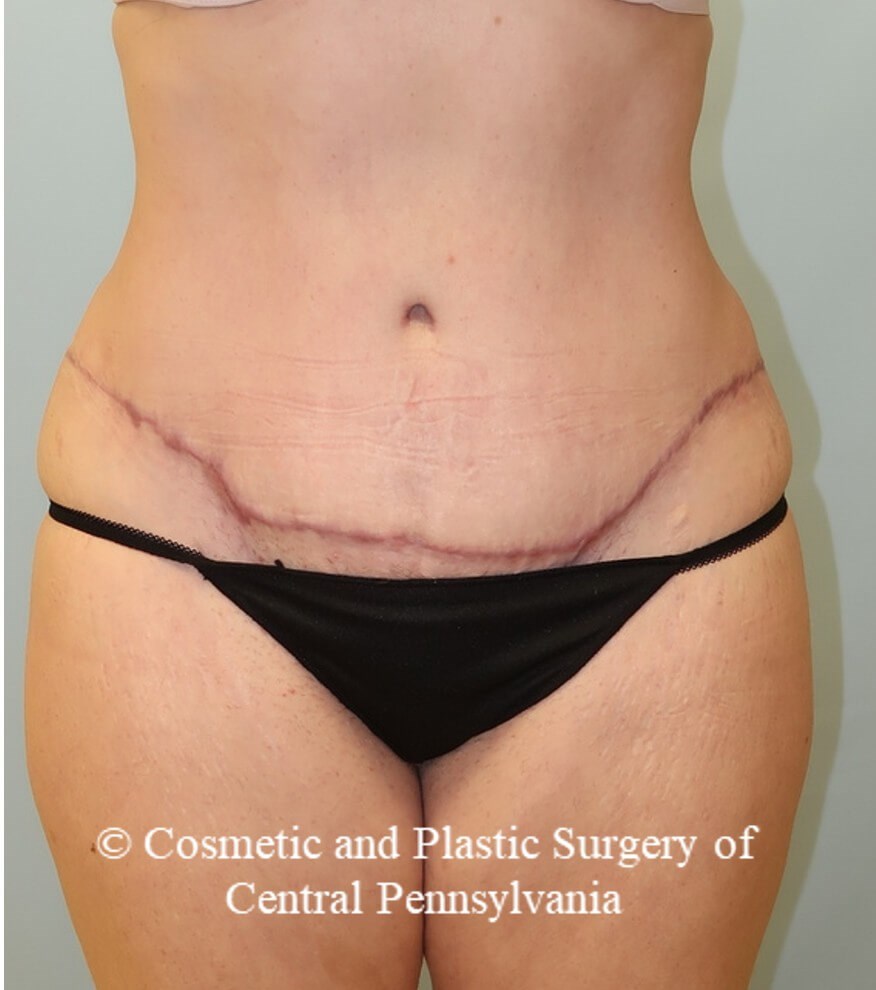 Abdominoplasty and liposuction After