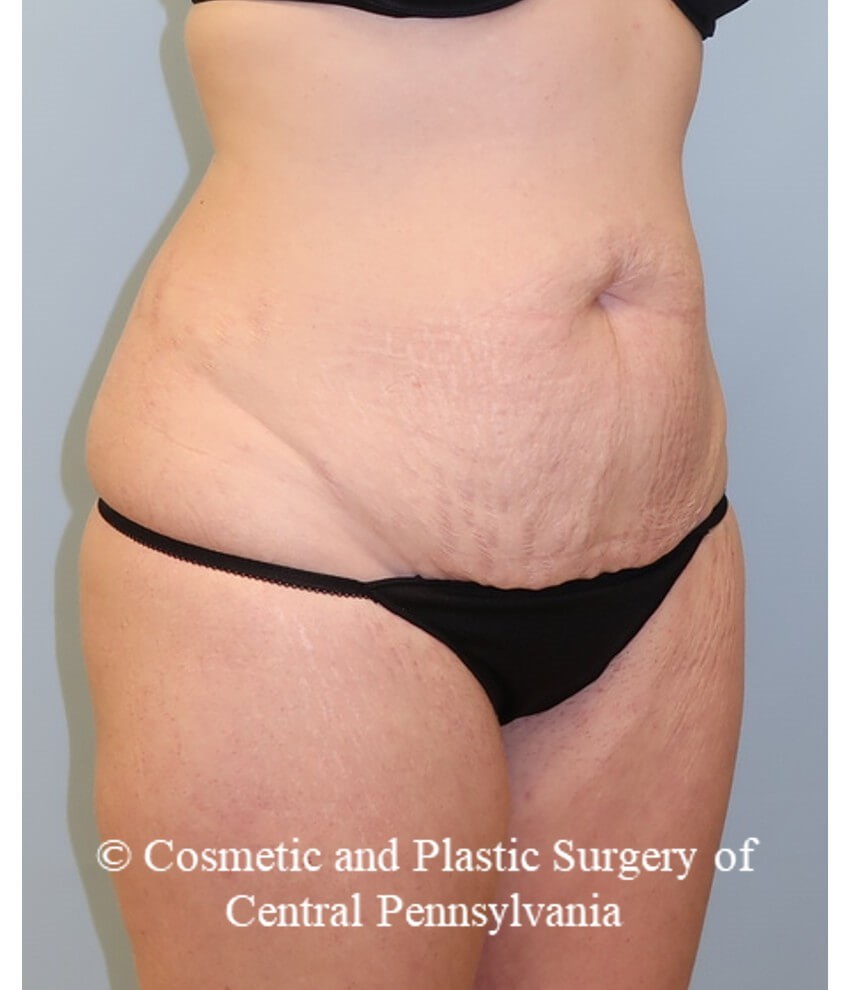 Abdominoplasty and liposuction Before