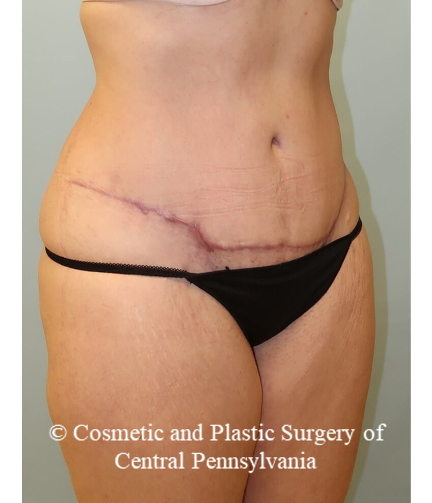 Abdominoplasty and liposuction After
