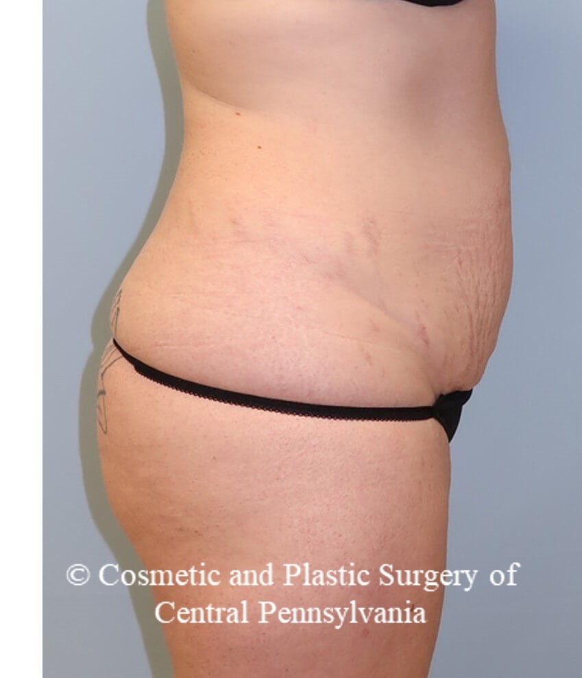Abdominoplasty and liposuction Before