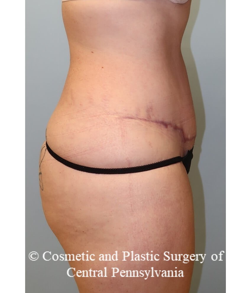 Abdominoplasty and liposuction After