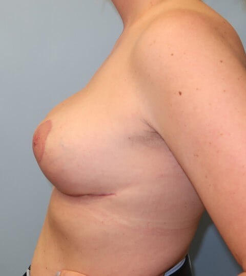 Breast Lift (Mastopexy) After