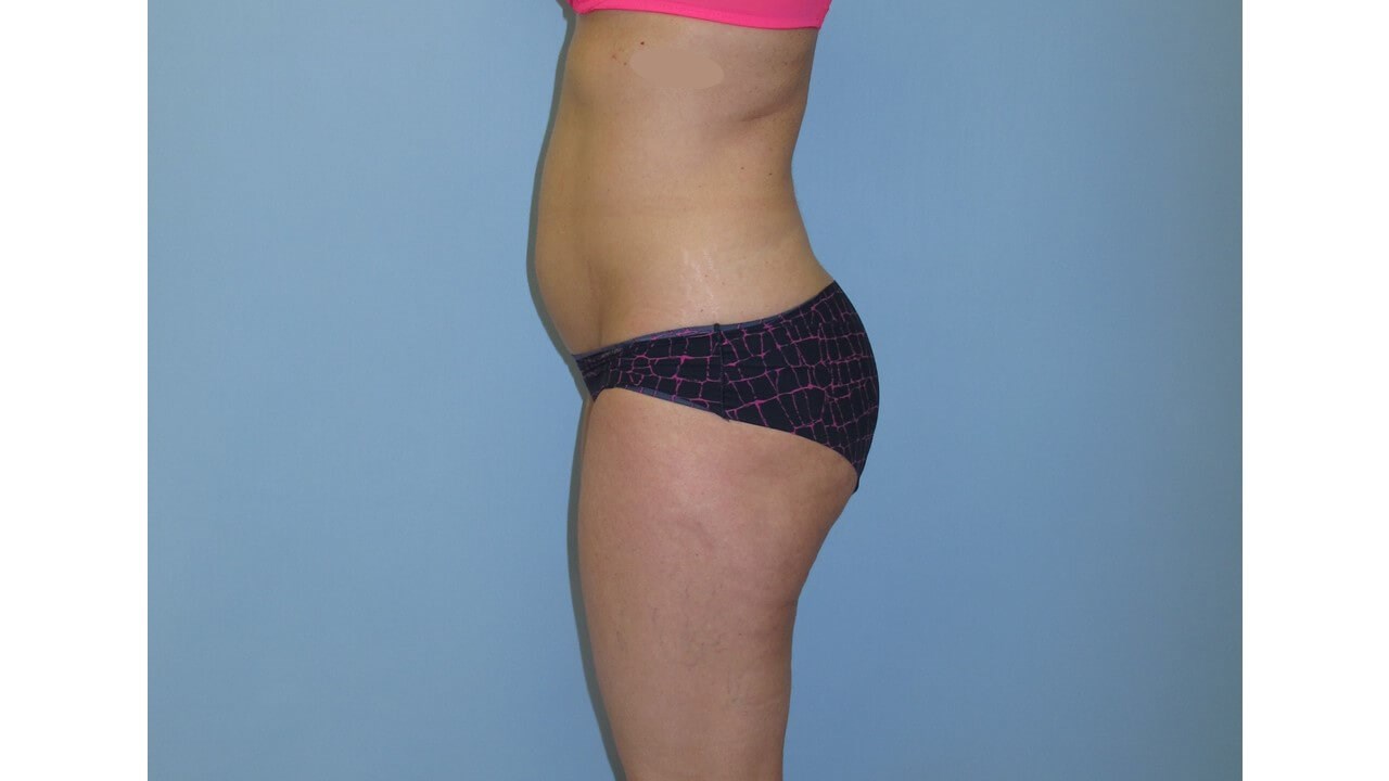 UltraShape Power & VelaShape Before (Side View)