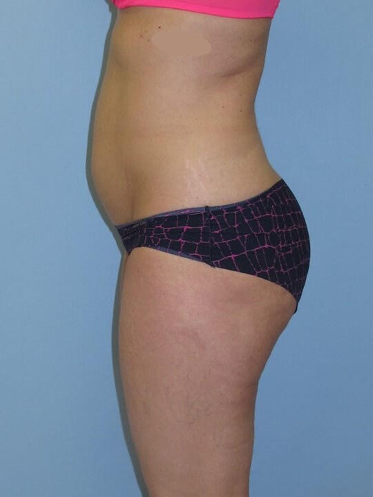 UltraShape Power & VelaShape Before (Side View)