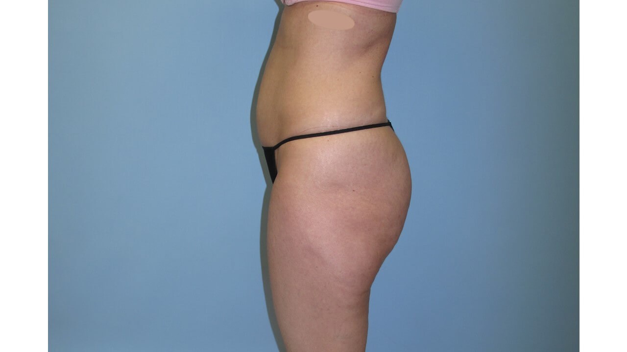 UltraShape Power & VelaShape After (Side View)