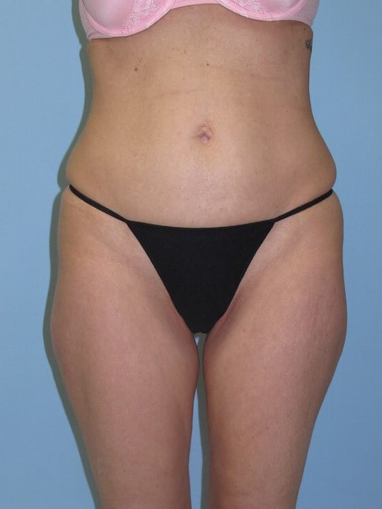 UltraShape Power & VelaShape After (Frontal View)