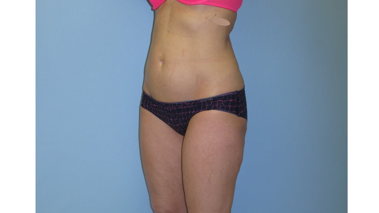 UltraShape Power & VelaShape Before (Oblique View)