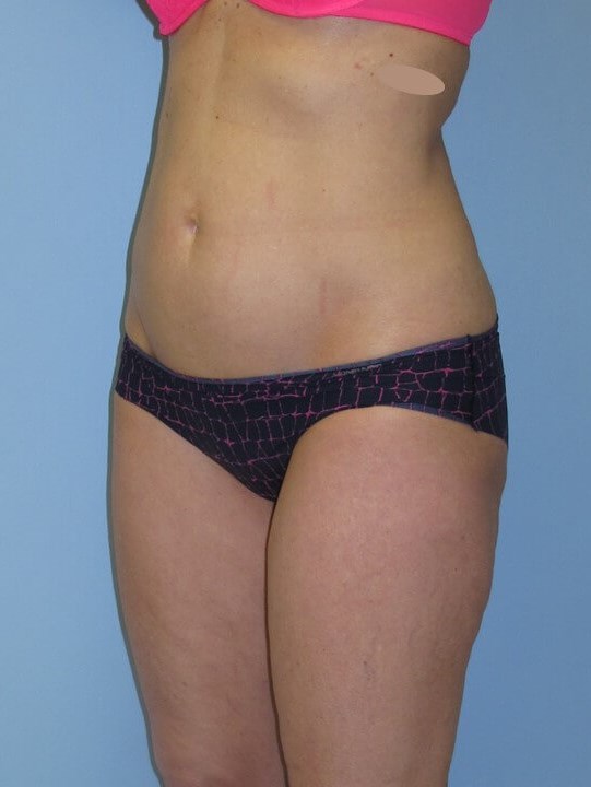 UltraShape Power & VelaShape Before (Oblique View)