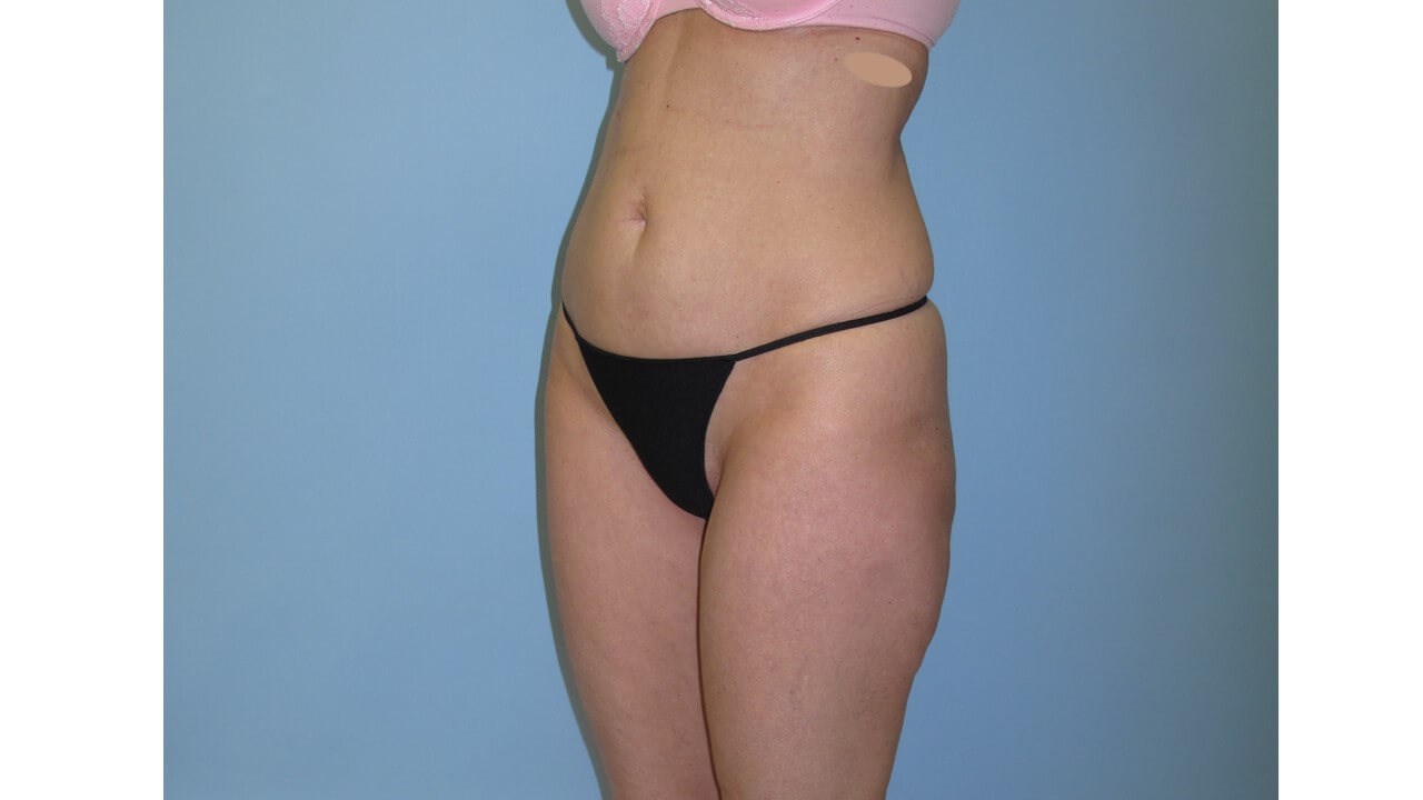 UltraShape Power & VelaShape After (Oblique View)