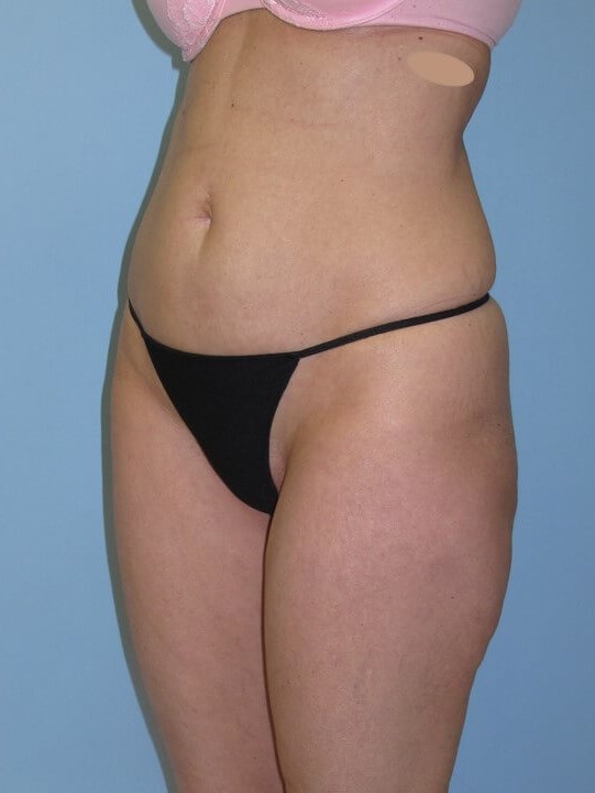 UltraShape Power & VelaShape After (Oblique View)