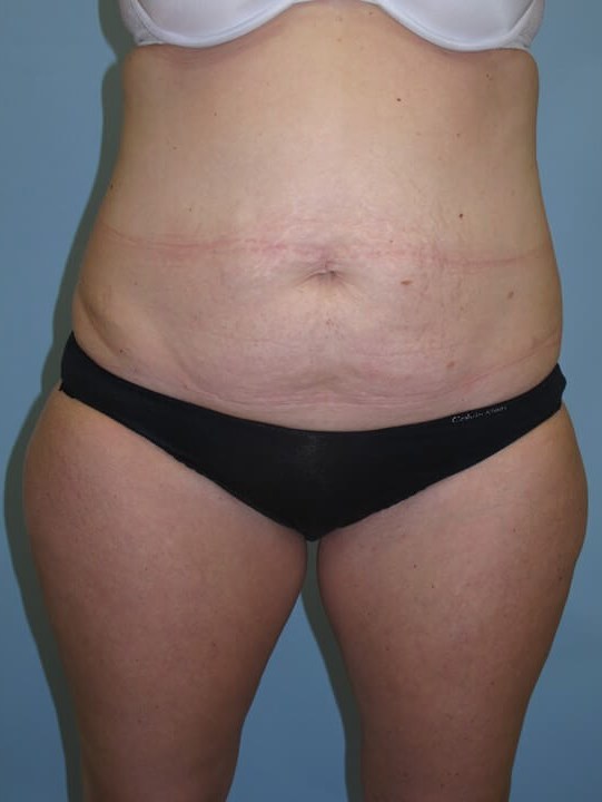 UltraShape Power & VelaShape Before (Frontal View)