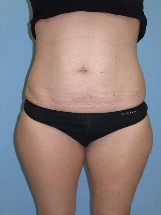 UltraShape Power & VelaShape Before (Frontal View)