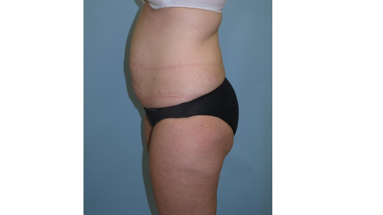 UltraShape Power & VelaShape Before (Side View)