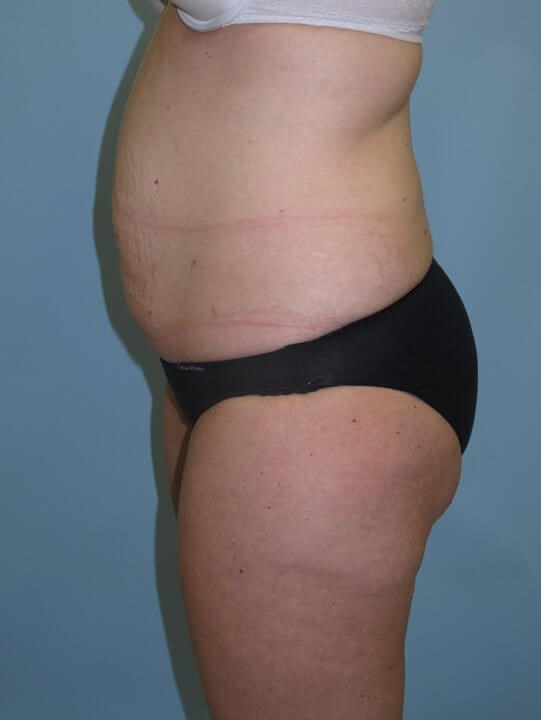 UltraShape Power & VelaShape Before (Side View)