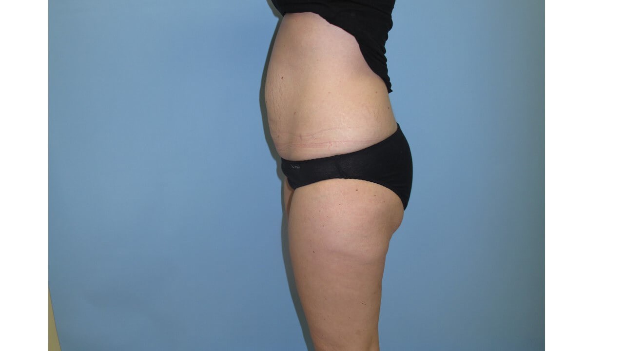 UltraShape Power & VelaShape After (Side View)