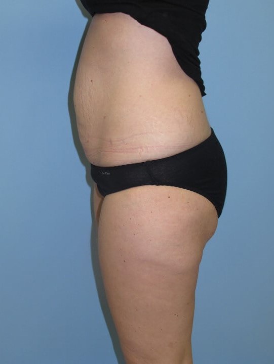 UltraShape Power & VelaShape After (Side View)