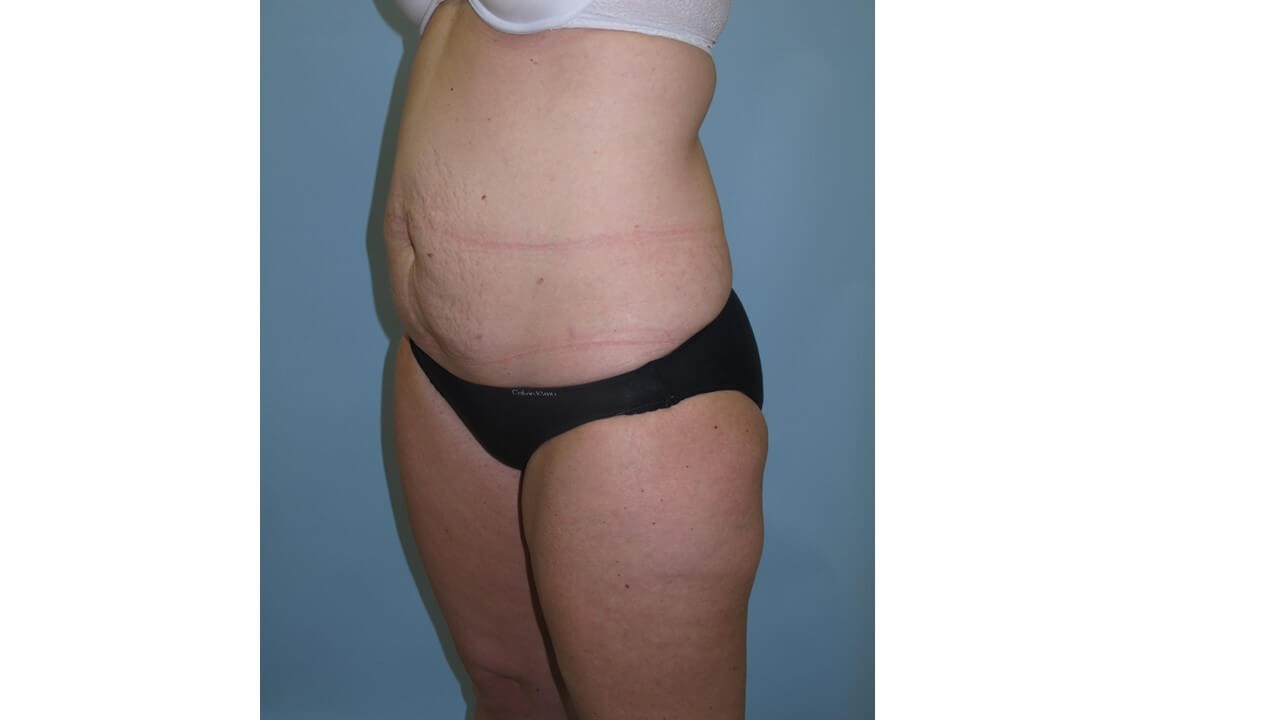 UltraShape Power & VelaShape Before (Oblique View)