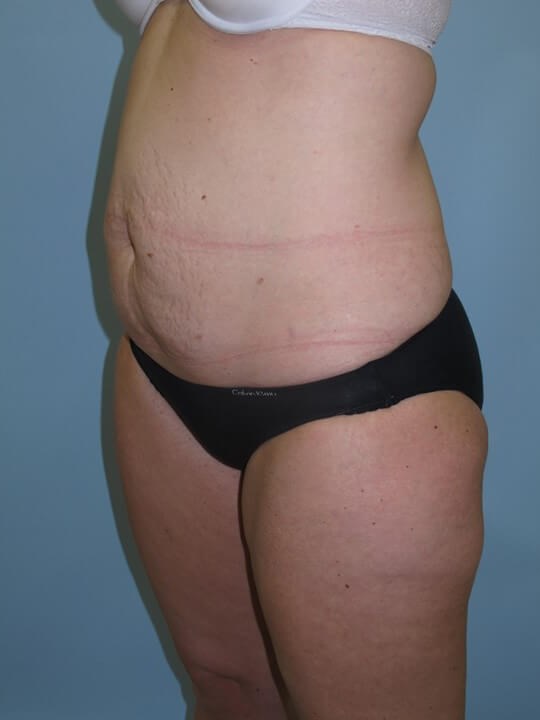 UltraShape Power & VelaShape Before (Oblique View)