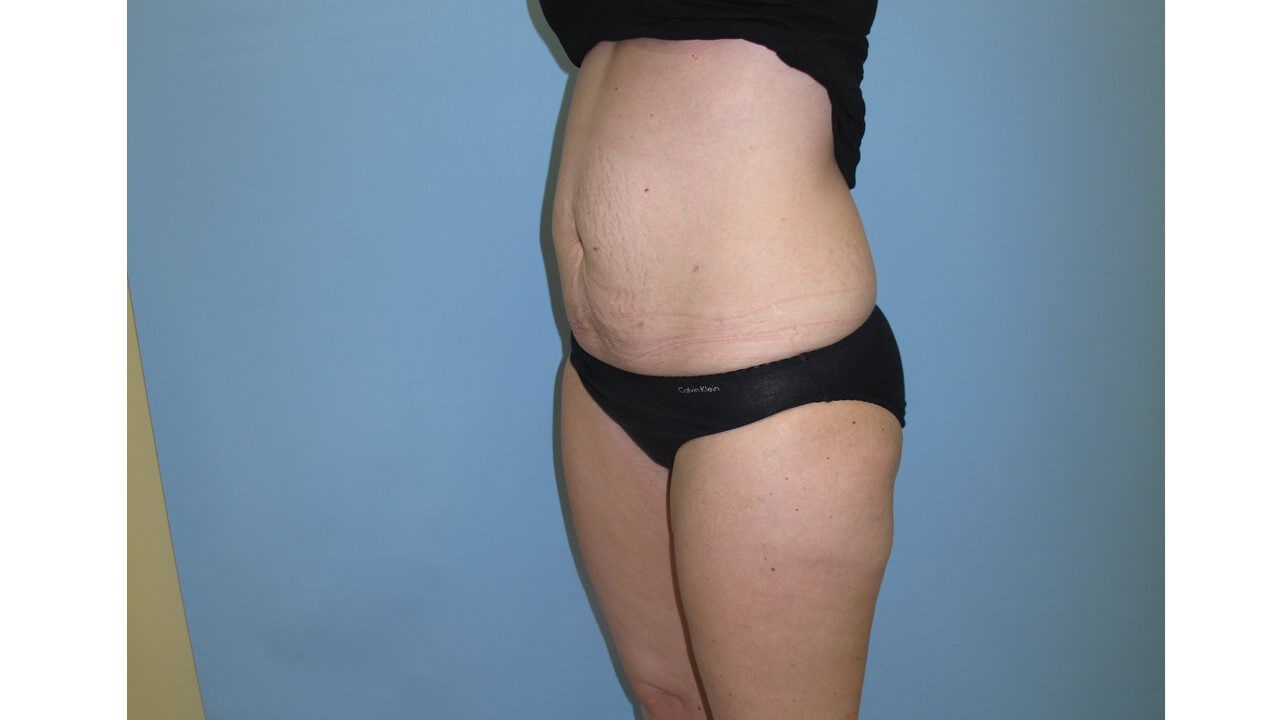 UltraShape Power & VelaShape After (Oblique View)