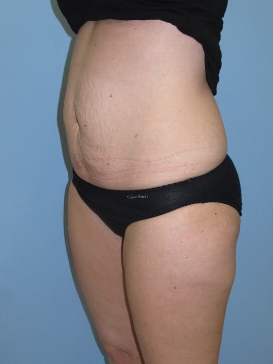 UltraShape Power & VelaShape After (Oblique View)