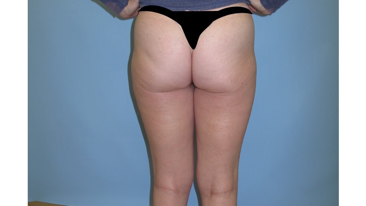 VelaShape III Before