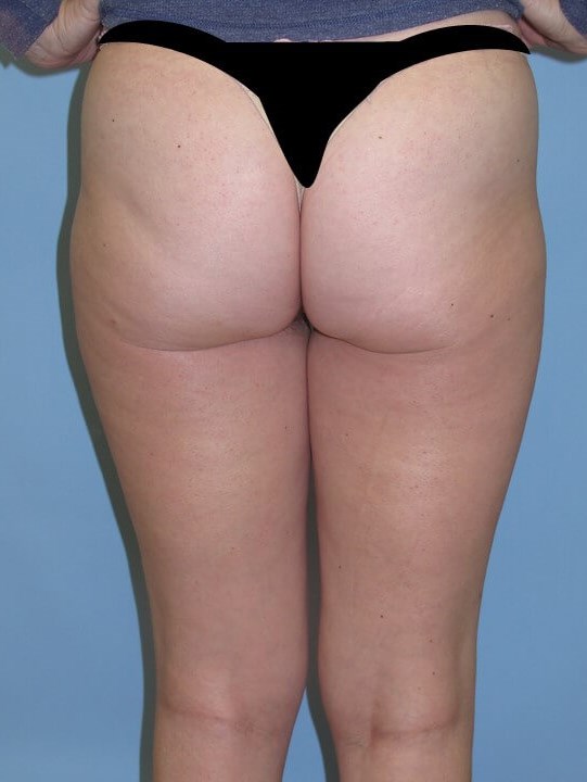 VelaShape III Before
