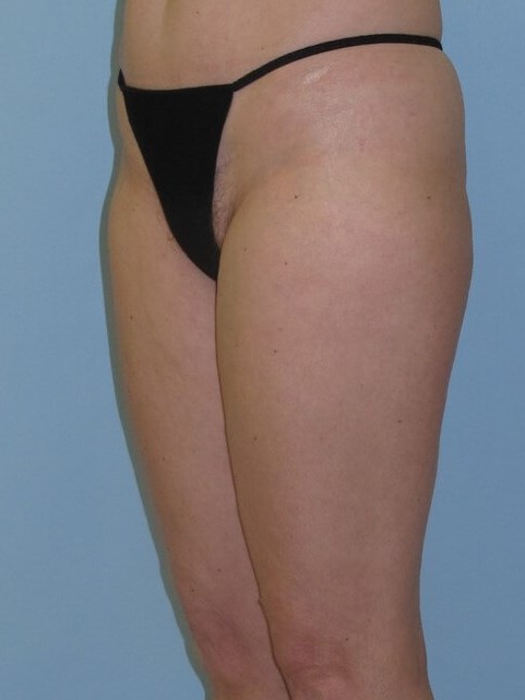 VelaShape III After