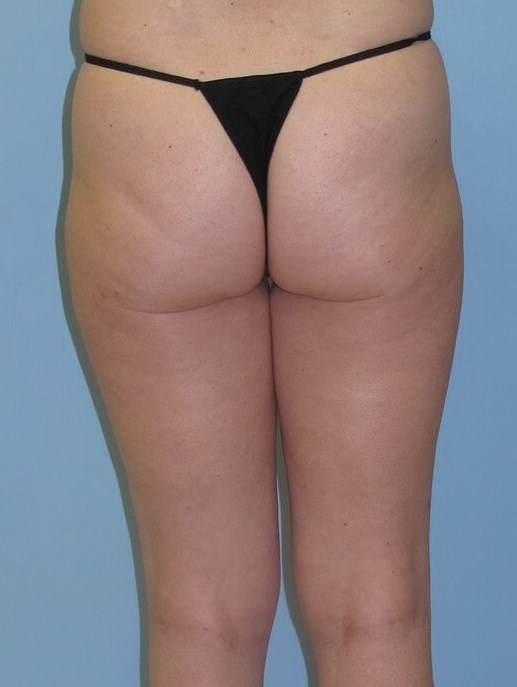 VelaShape III After