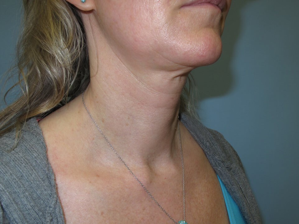 VelaShape III for the neck Before