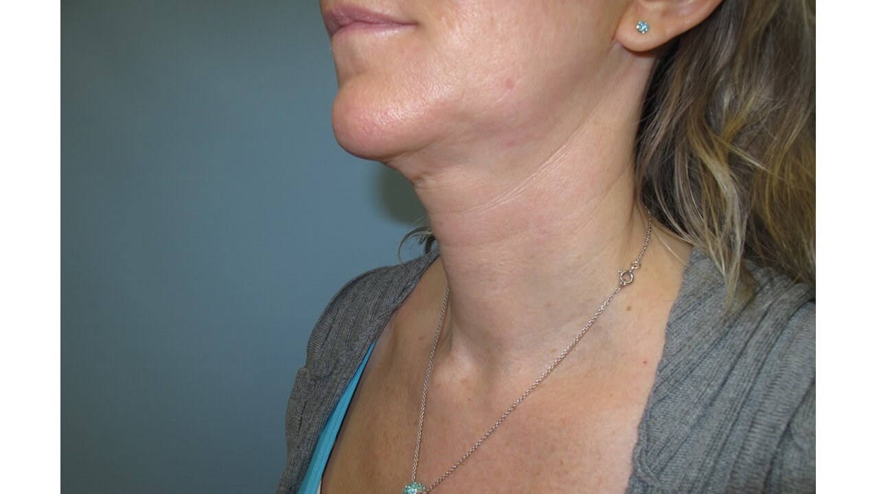VelaShape III for the neck Before