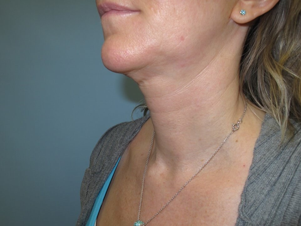 VelaShape III for the neck Before
