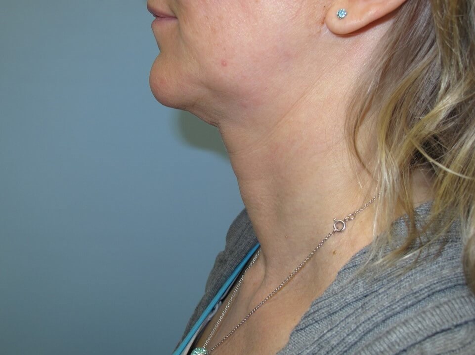 VelaShape III for the neck Before